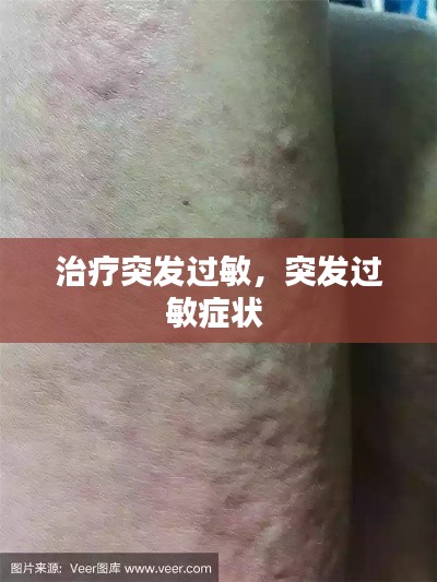 治疗突发过敏，突发过敏症状 