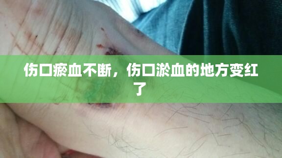 伤口瘀血不断，伤口淤血的地方变红了 